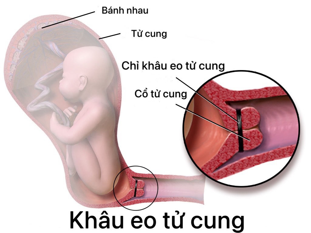 cổ tử cung ngắn