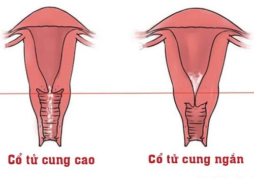 cổ tử cung ngắn