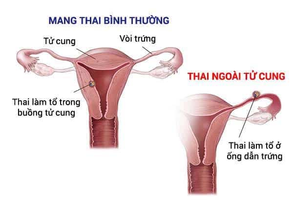 dấu hiệu mang thai ngoài tử cung