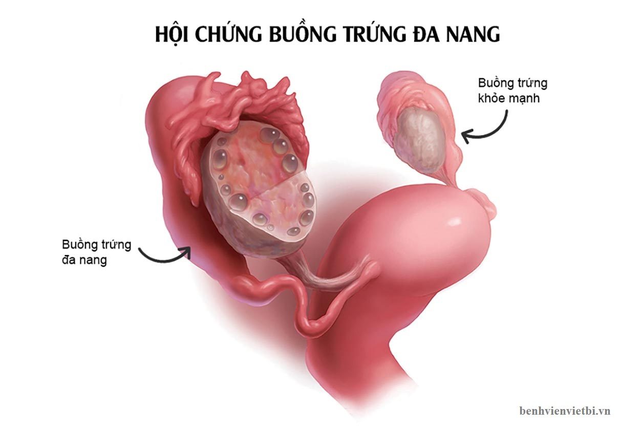 hội chứng buồng trứng đa nang