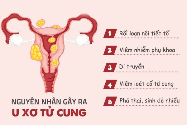 nguyên nhân u xơ tử cung 