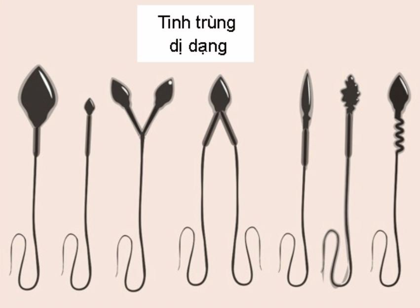 tinh trùng dị dạng