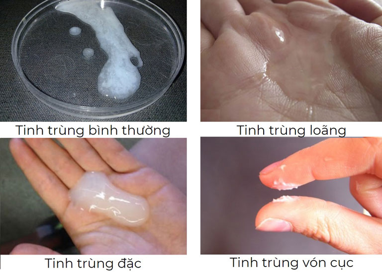 tinh trùng loãng