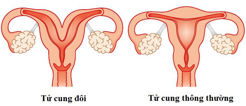 tư cung đôi