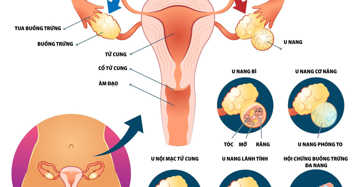 phân loại u nang buồng trứng