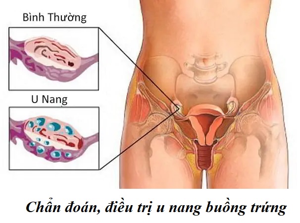 u nang buồng trứng