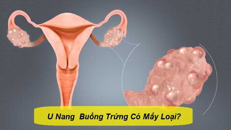 u nang buồng trứng