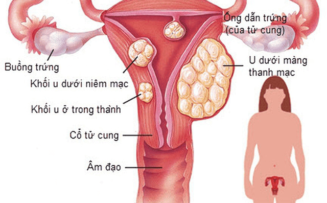 u xơ tử cung là gì