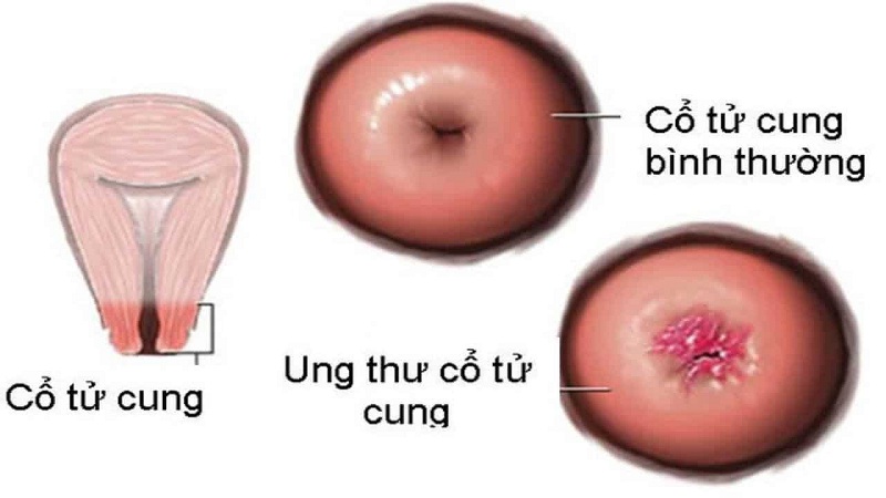 Ung thư cổ tử cung là gì