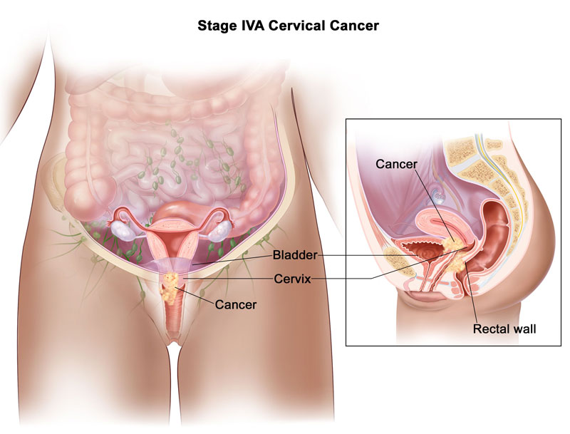 Ung thư cổ tử cung