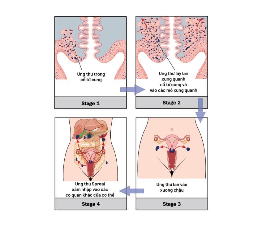 ung thư cổ tư cung giai đoạn cuối