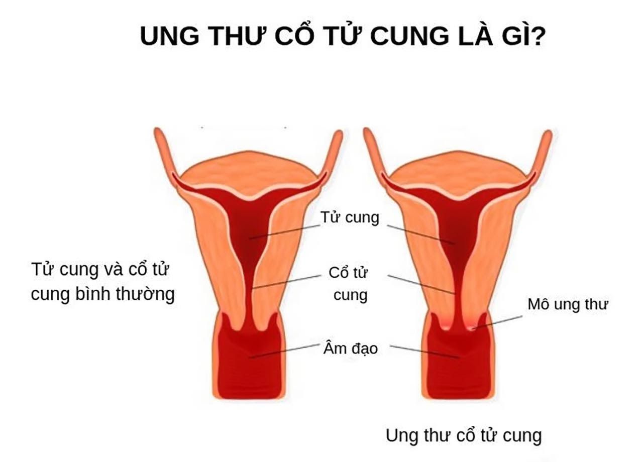 ung thư cổ tử cung là gì