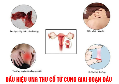 ung thư cổ tử cung giai đoạn đầu