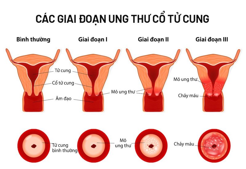 ung thư cổ tử cung là gì