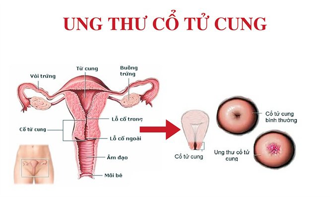 ung thư cổ tử cung