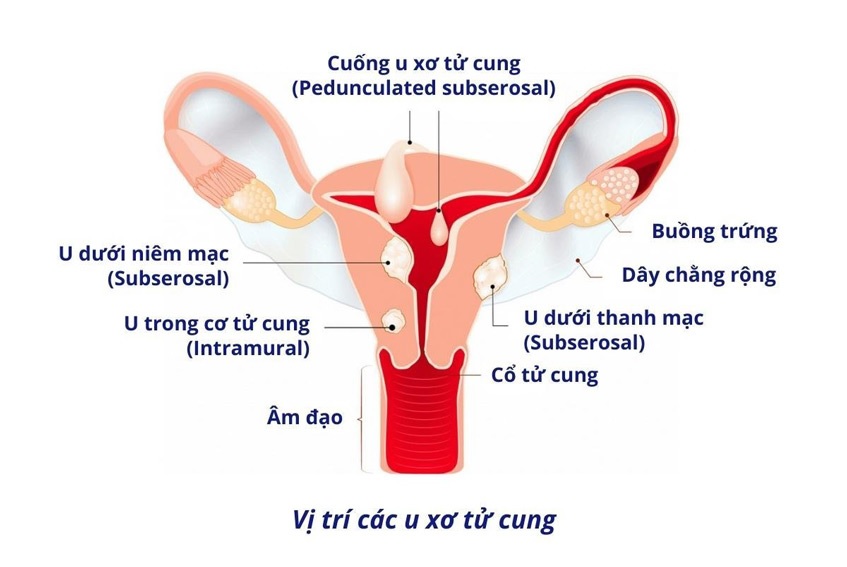 u xơ tử cung